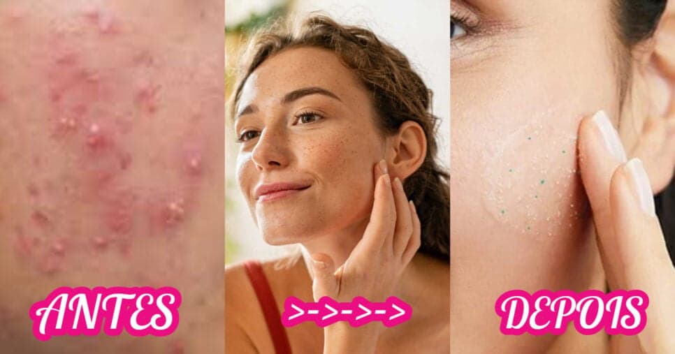 Fim da acne: 5 dicas para evitar ter espinhas no rosto de uma vez por todas