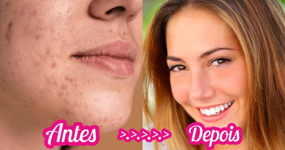 Para eliminar pontos pretos no nariz: 5 truques práticos para acabar com cravos no rosto