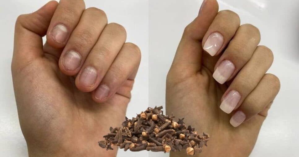 Como fazer solução caseira com cravo para ter unhas fortes e longas e se livrar do gasto no salão