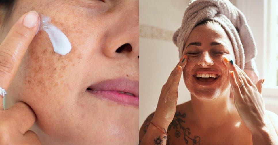 Adeus, manchas: 3 pomadas que ajudam a tirar o melasma do rosto
