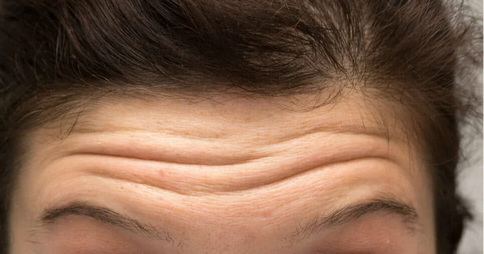 Os 3 truques de beleza para evitar rugas na testa sem botox
