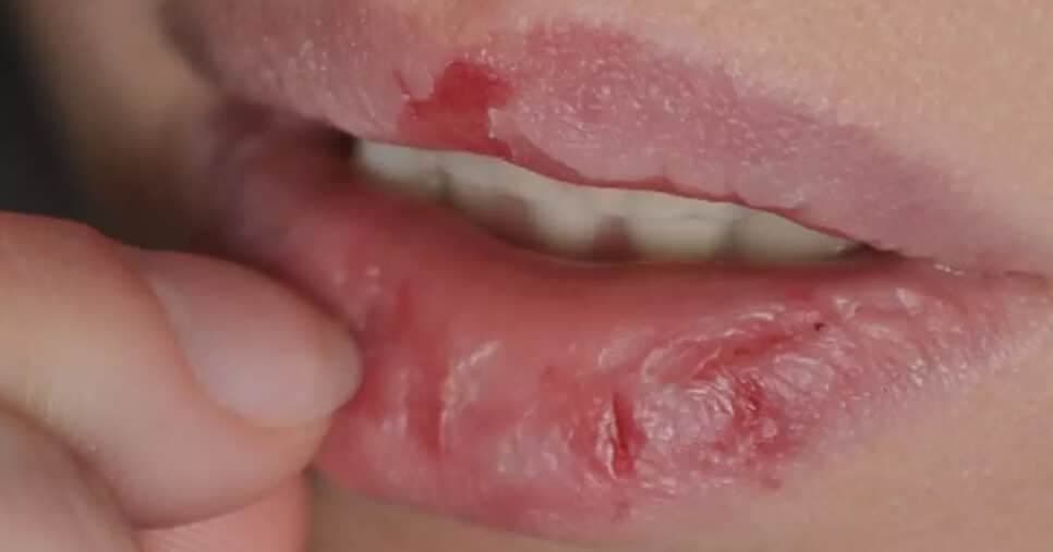 3 ingredientes: Óleo natural caseiro perfeito para hidratar os lábios no inverno