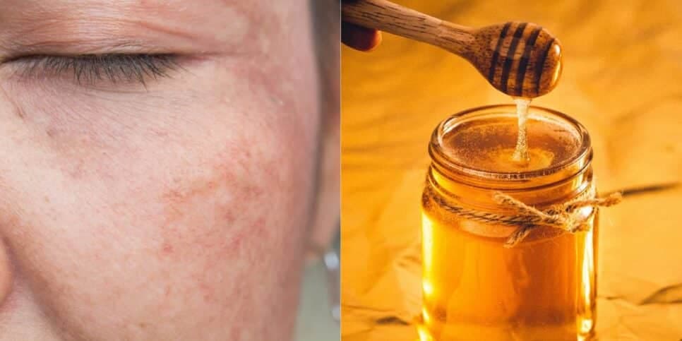 Como preparar um sérum natural com mel para clarear manchas