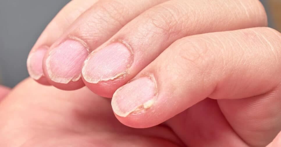 Unhas quebrando toda hora? Descubra o que pode estar por trás