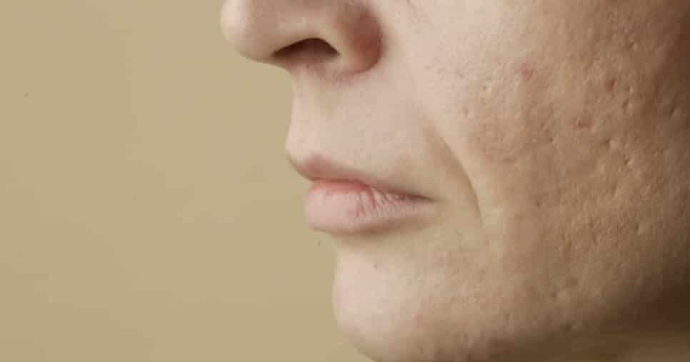 Pioram as rugas: 5 erros comuns que você precisa evitar para não destruir o seu rosto