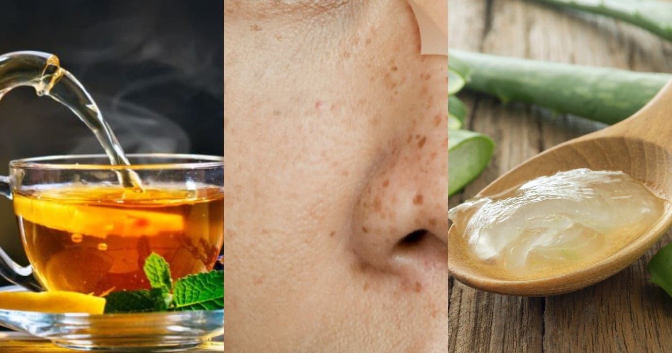 Chá e babosa: 2 receitas caseiras para acabar com as manchas no rosto