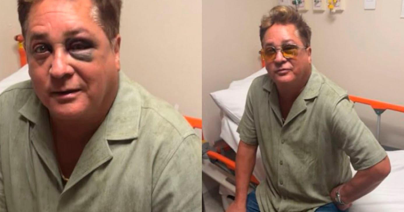 Cantor Leonardo sofre acidente e aparece com olho roxo (Foto: Reprodução)