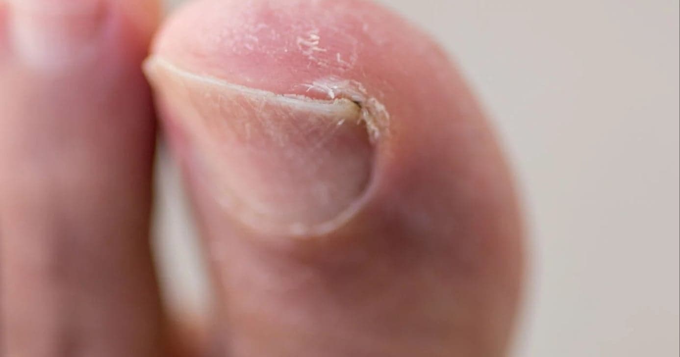 Adeus, dor: 4 dicas definitivas para acabar com as unhas encravadas em 2026