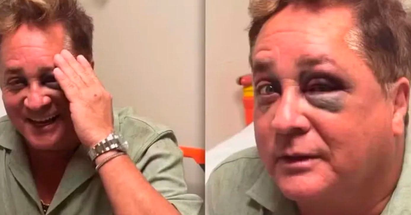 Cantor Leonardo sofre acidente e aparece com olho roxo (Foto: Reprodução)