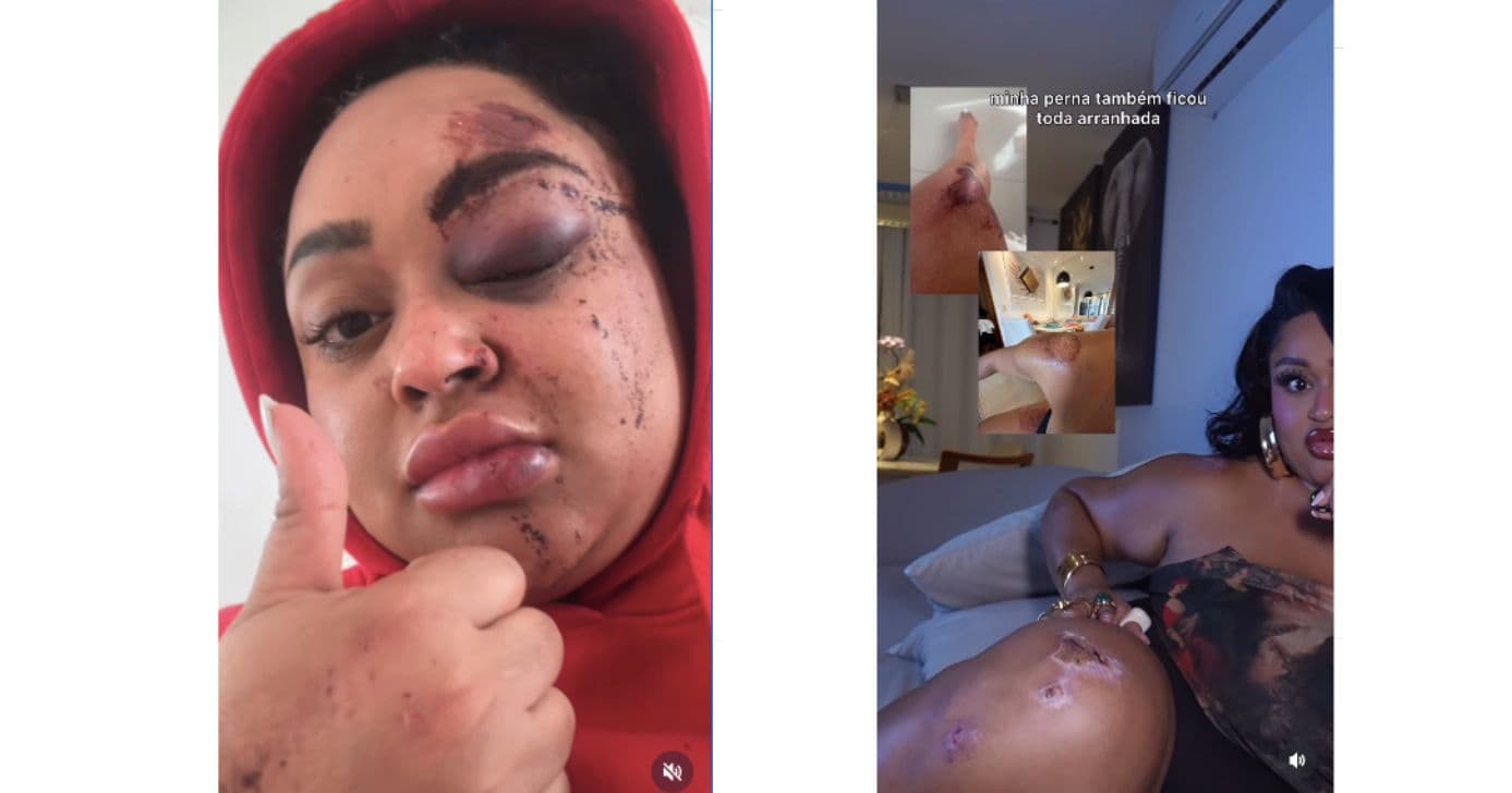 Rízia Cerqueira, ex-participante do BBB, mostra como ficou após acidente (Foto: Reprodução / Instagram) 