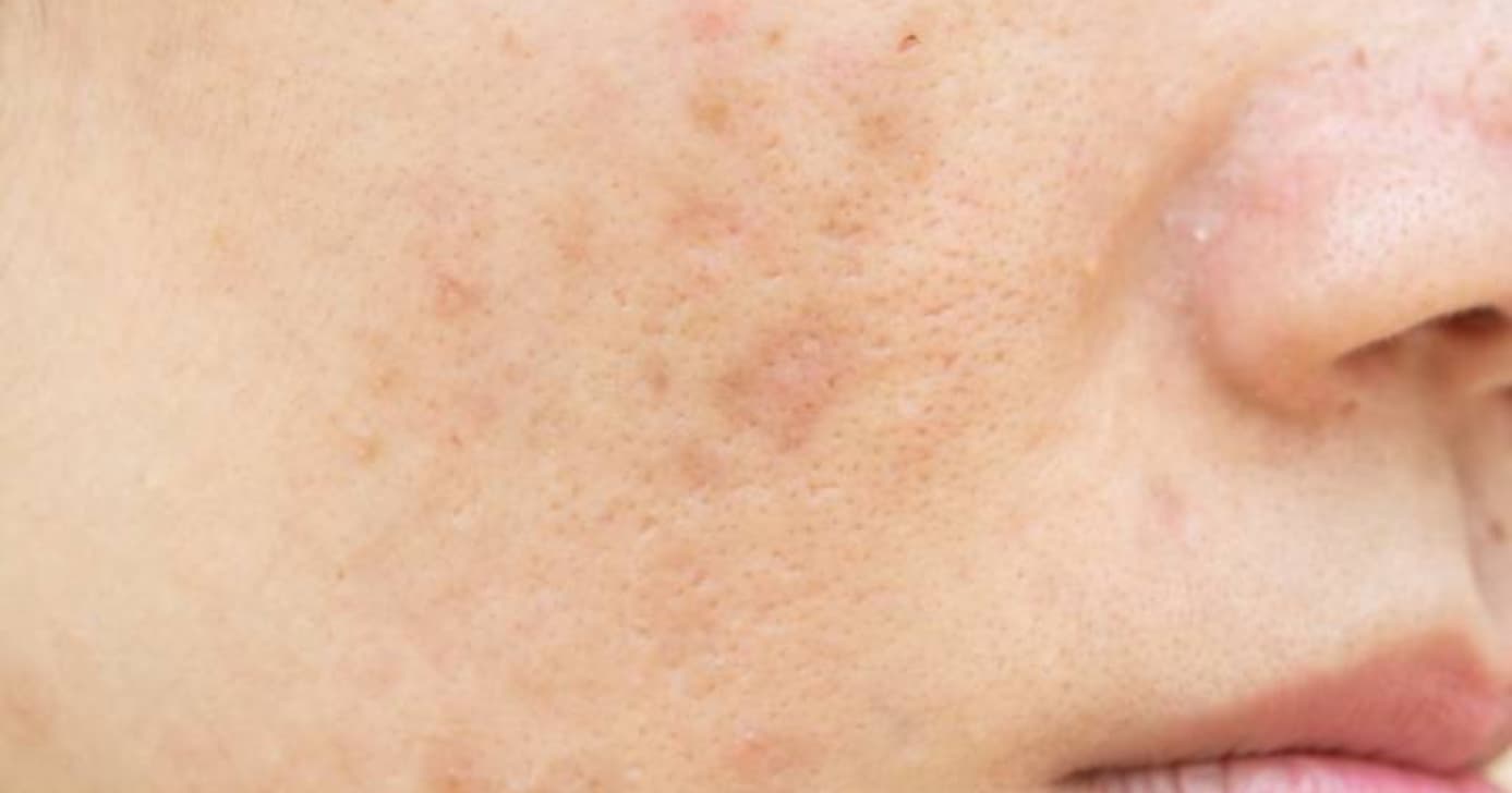 Fim das manchas escuras: As 2 dicas caseiras para se livrar de pesadelo na pele