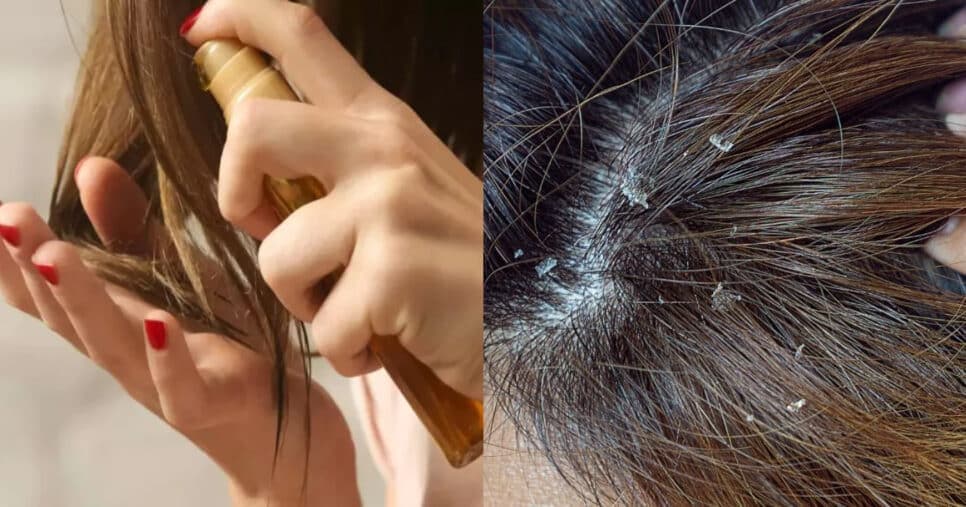 Óleo essencial pouco conhecido elimina a caspa do seu cabelo e salva seus fios