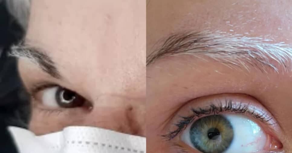 Fios brancos na sobrancelha: 2 motivos para perda da colocação