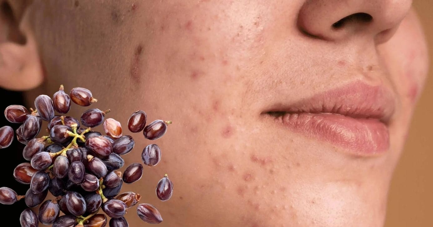 Adeus, oleosidade: Óleo essencial elimina cravo naturalmente e deixa pele sequinha