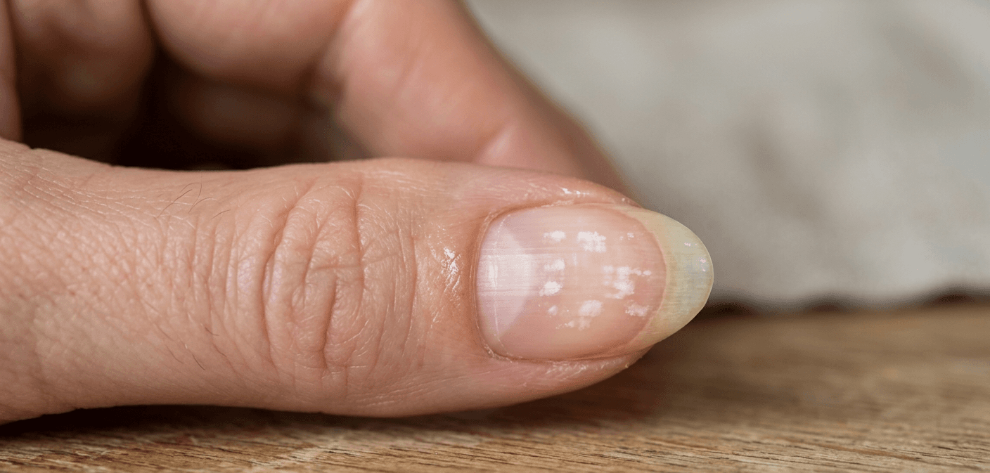Unhas com manchas brancas (Foto: Montagem TV Foco / GMN)