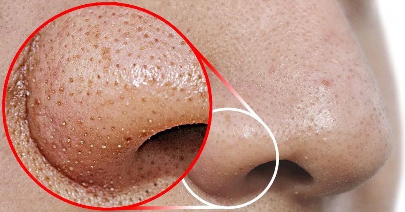 Elimine os pontos pretos no nariz: 4 truques práticos para acabar com cravos no rosto