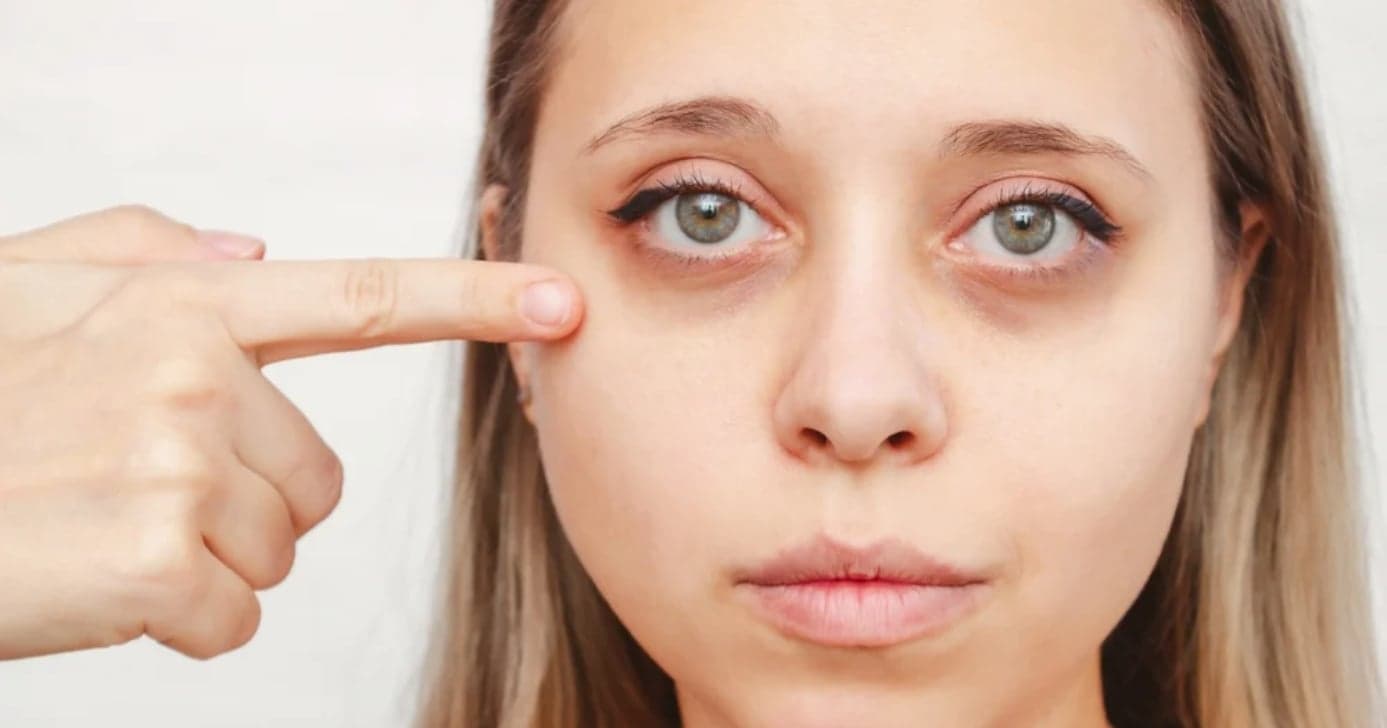 8 causas das olheiras que você precisa conhecer para começar a evitar