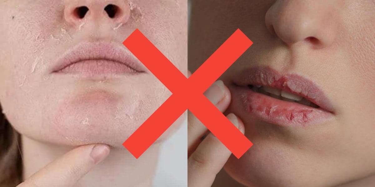 Não precisa de creme hidratante: Como evitar lábios rachados e pele seca no frio com 1 ingrediente natural
