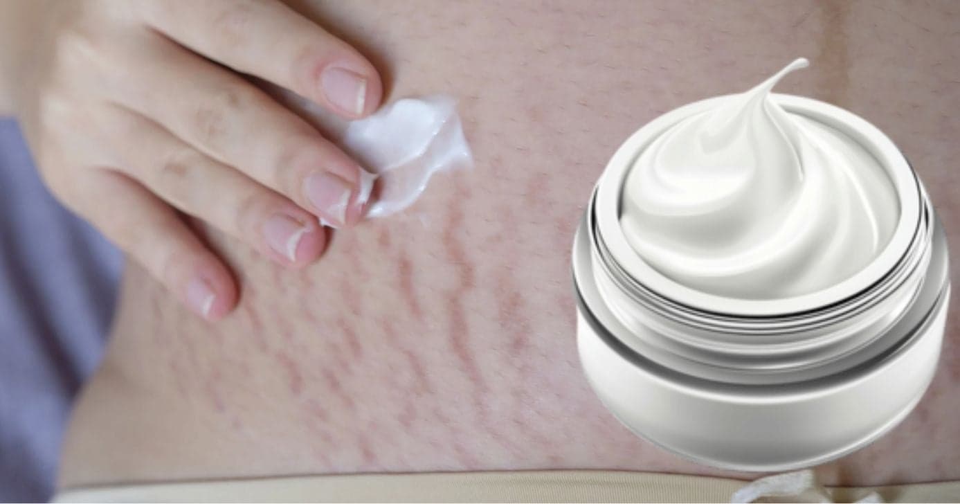 Estrias: Creme de farmácia recupera elasticidade da pele flácida