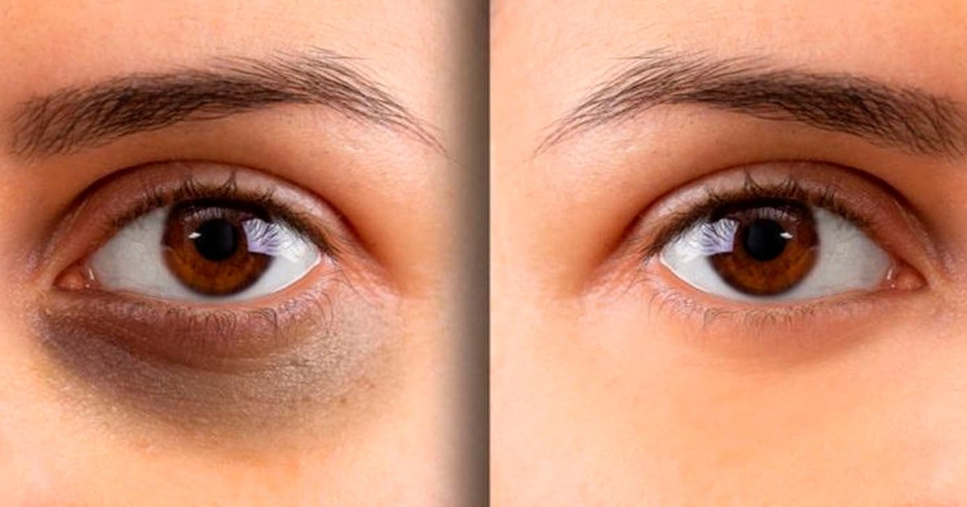 Adeus, preenchimento: Como reduzir olheiras e olhos inchados com cotonete em 10 minutos
