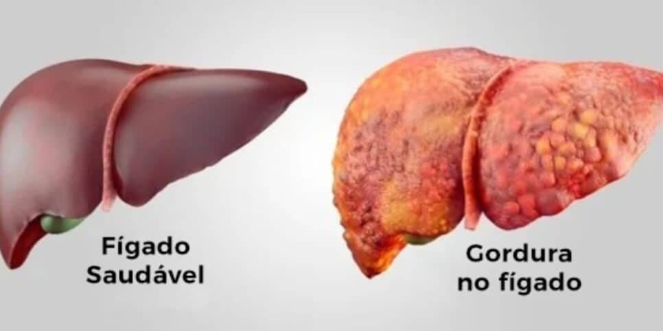Gordura no fígado (Reprodução/Clínica Átrios) Gordura no fígado (Reprodução/Clínica Átrios)
