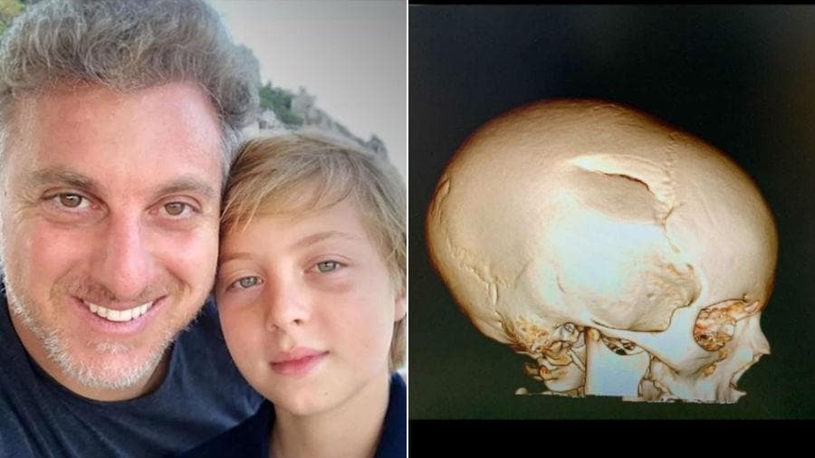 Luciano Huck exibiu raio-x do crânio de Benício (Reprodução: Instagram) Luciano Huck exibiu raio-x do crânio de Benício (Reprodução: Instagram)