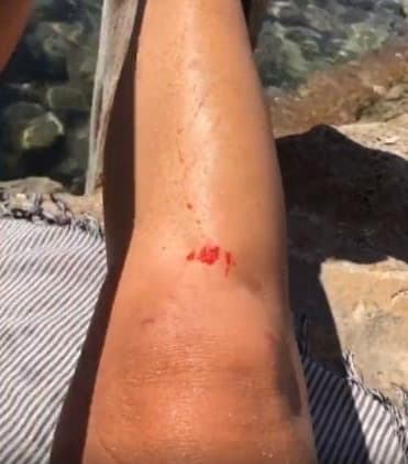 Luana Piovani exibe machucado na perna após acidente (Foto: Reprodução/Instagram) Luana Piovani exibe machucado na perna após acidente (Foto: Reprodução/Instagram)