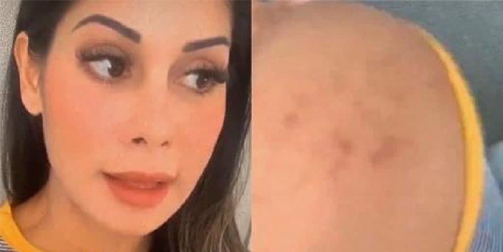 Mayra Cardi diz estar com o corpo todo empolado (Foto: Montagem) Mayra Cardi diz estar com o corpo todo empolado (Foto: Montagem)