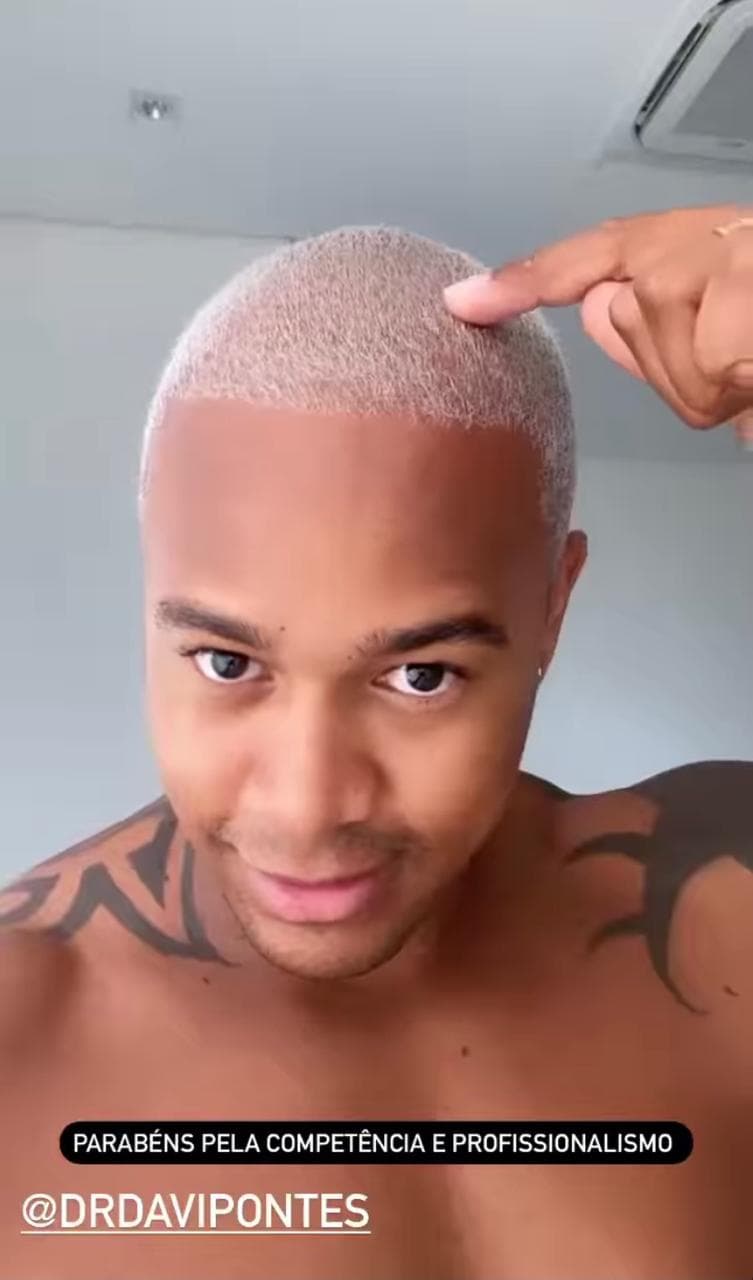 Artista aparece sem camisa para celebrar transplante capilar (Reprodução: Instagram) Artista aparece sem camisa para celebrar transplante capilar (Reprodução: Instagram)