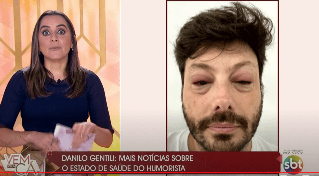 Gentili ficou com o rosto desfigurado ao vivo (Foto reprodução) Gentili ficou com o rosto desfigurado ao vivo (Foto reprodução)