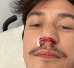 Durante treino, Ginasta Arthur Nory cai de barra, sofre com fraturas pelo corpo e foto ensanguentado vaza: "Cirurgia"