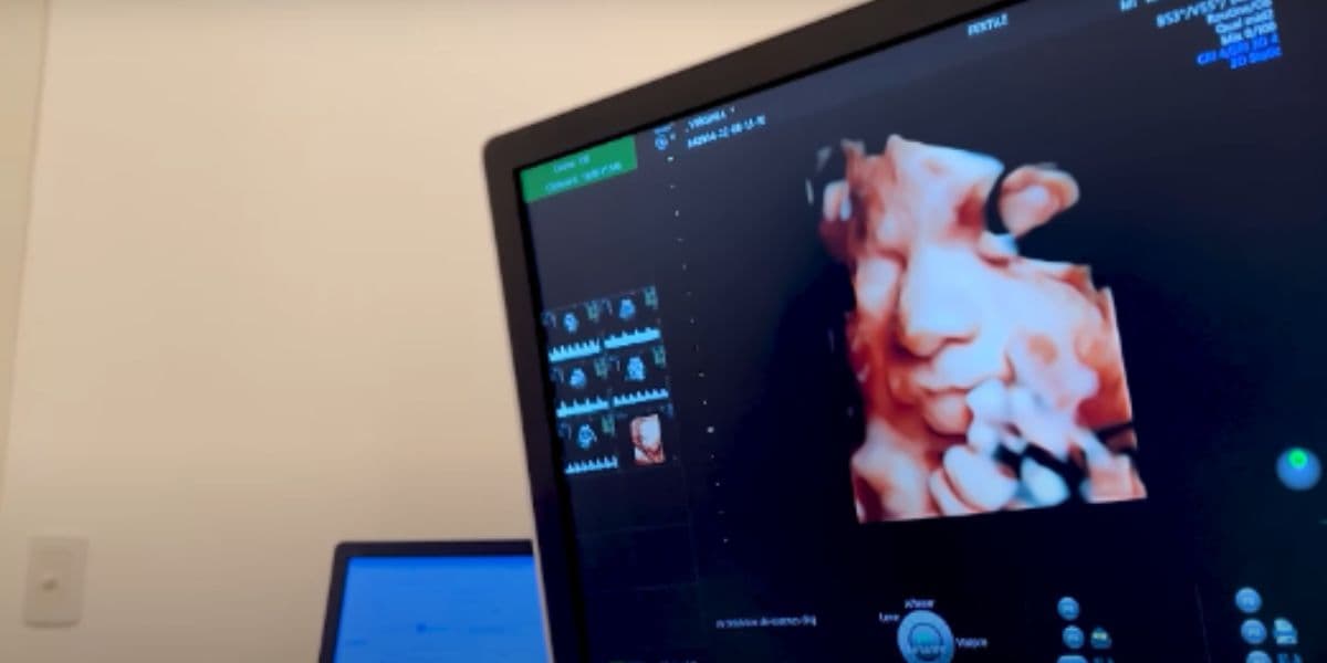 Virgínia Fonseca mostra pela primeira vez o rostinho de sua caçula em ultrassom 3D Virgínia Fonseca mostra pela primeira vez o rostinho de sua caçula em ultrassom 3D