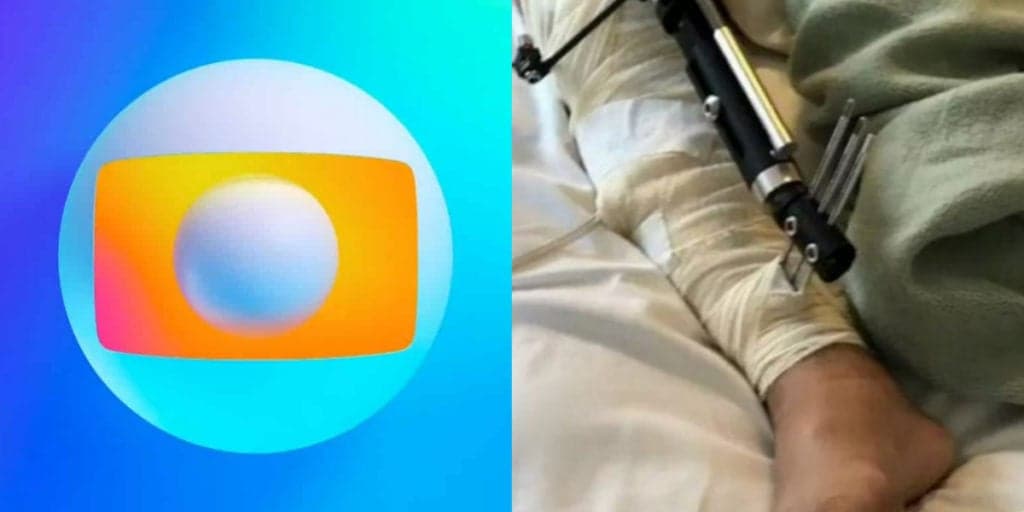 Ator, que foi galã da Globo, teve perna necrosada e acabou sofrendo com 65 cirurgias: “Tiveram que tirar 80%”