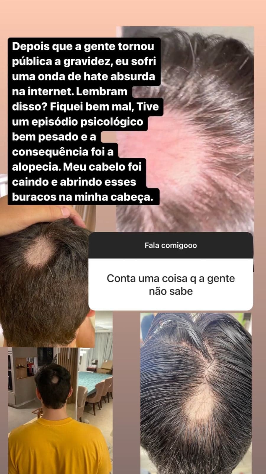 O Ex-BBB, Eliezer, mostrou aos fãs, o resultado da Alopecia, doença que teve logo após a Viih Tube anunciar a gravidez (Reprodução - Instagram) O Ex-BBB, Eliezer, mostrou aos fãs, o resultado da Alopecia, doença que teve logo após a Viih Tube anunciar a gravidez (Reprodução - Instagram)