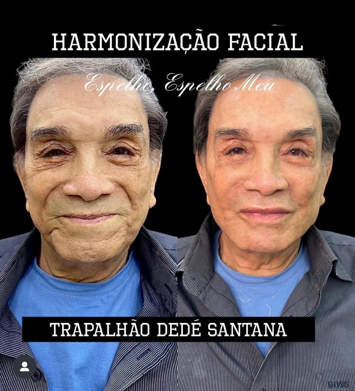 Dedé Santana em antes e depois de procedimento estetico que o rejuvenesceu 30 anos - Foto Reprodução Instagram Dedé Santana em antes e depois de procedimento estetico que o rejuvenesceu 30 anos - Foto Reprodução Instagram