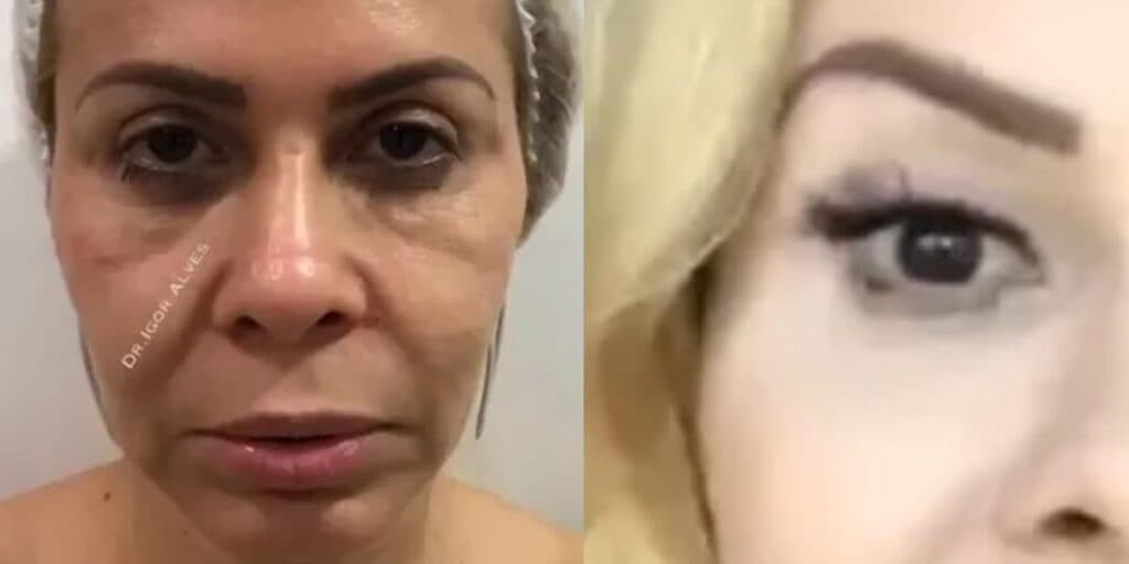 Procedimento no rosto realizado por Joelma a faz rejuvenescer 20 anos e foto de antes e depois choca
