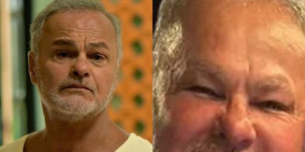 Kadu Moliterno, fora da Globo, faz procedimento no rosto, mostra resultado e rejuvenesce 20 anos
