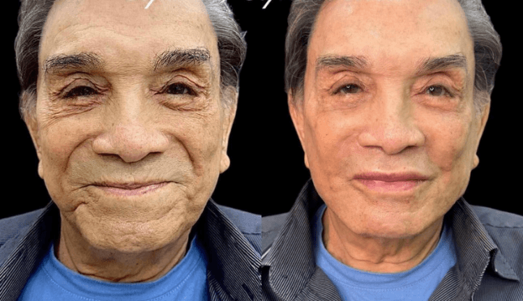 O famoso humorista surpreende com jovialidade ao fazer harmonização facial - Foto Instagram O famoso humorista surpreende com jovialidade ao fazer harmonização facial - Foto Instagram