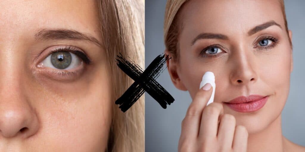 Fim das olheiras: Ingrediente secreto que você tem em casa dão adeus ao escuro dos olhos em 3 passos