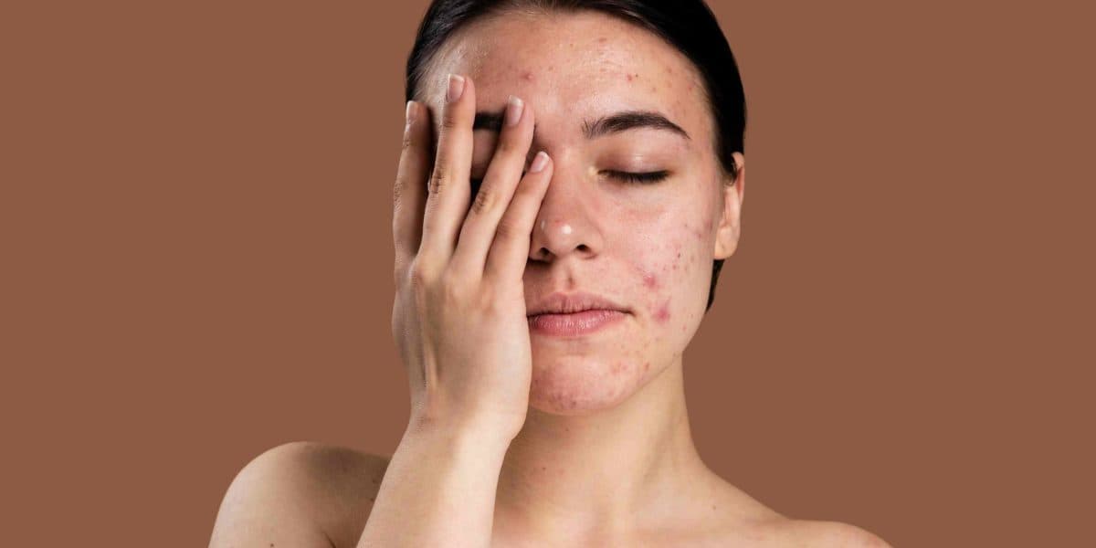 Detox facial para prevenir espinhas e cravos (Foto: Reprodução/ Internet) Detox facial para prevenir espinhas e cravos (Foto: Reprodução/ Internet)