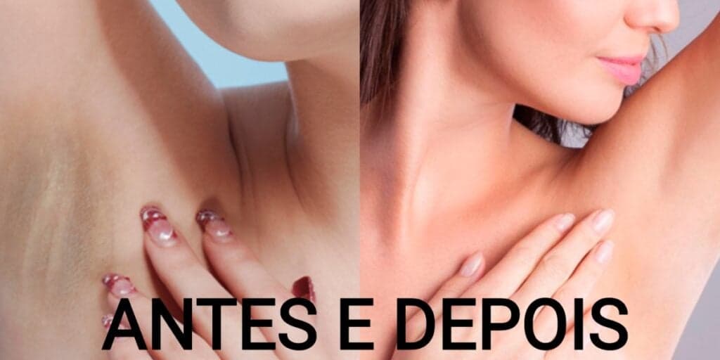 Fim das axilas escuras: Misturinha com 3 ingredientes dá adeus às manchas em 5 minutos