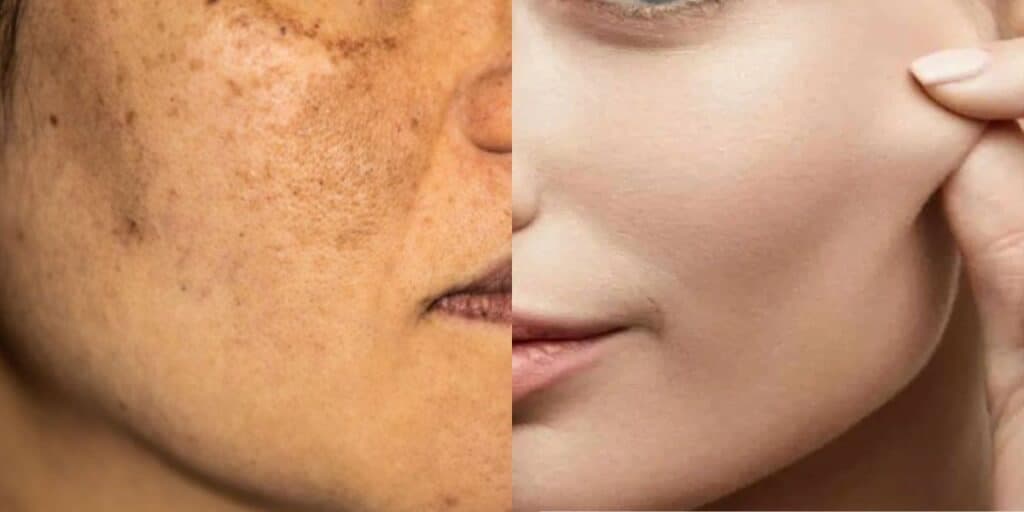 Extermina manchas escuras, o melasma e é melhor que laser: Receitinha natural com argila pra clarear pele