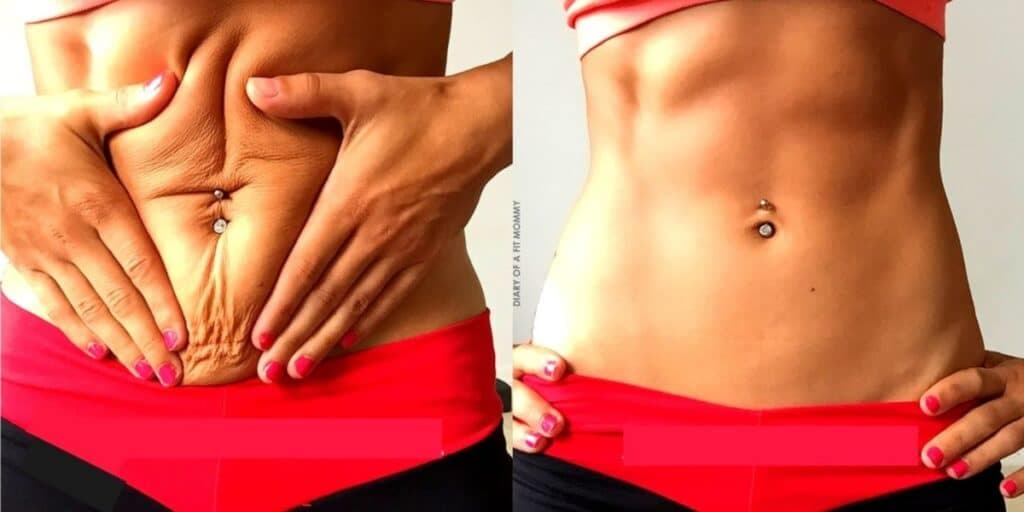 Barriga flácida nunca mais: 4 dicas INFALÍVEIS para garantir uma pele firme sem precisar de academia