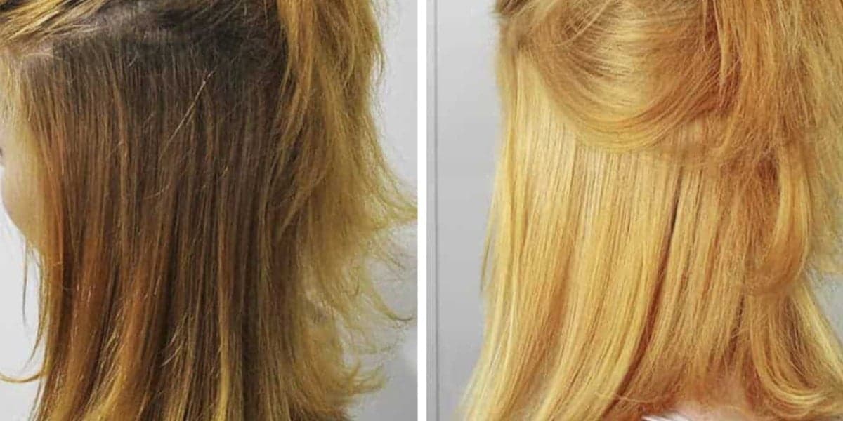 Antes e depois do clareamento gradativo com o uso da receita (Foto: Reprodução/ Internet) Antes e depois do clareamento gradativo com o uso da receita (Foto: Reprodução/ Internet)