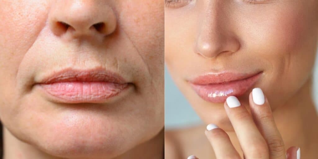 Fim do bigode chinês: Apenas 3 passos caseiros acabam com o pesadelo das mulheres e rejuvenesce em 5 minutos