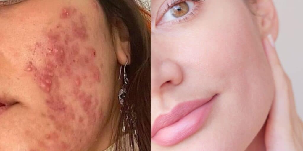 Pele com espinhas / Pele sem espinhas - Montagem TVFOCO Pele com espinhas / Pele sem espinhas - Montagem TVFOCO