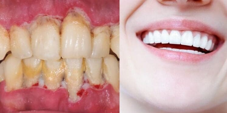 Adeus bafo e manchas nos dentes: Receita caseira com 2 ingredientes limpa a boca de dentro pra fora em minutos