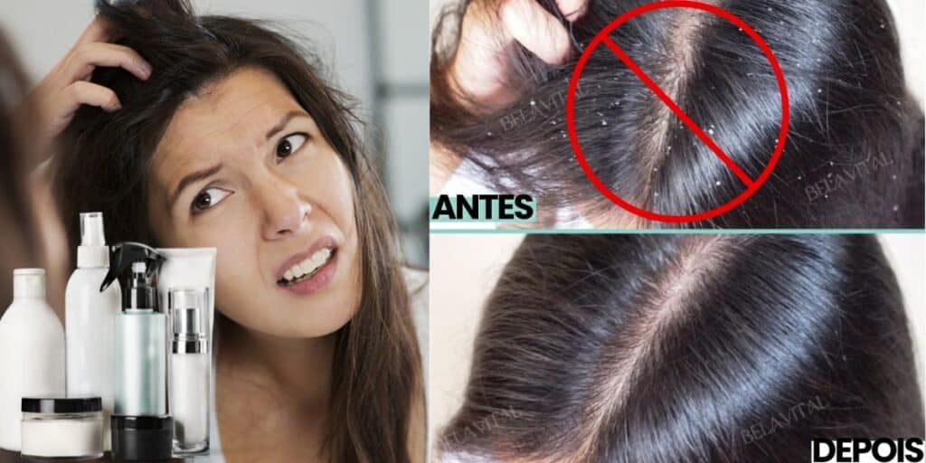 Adeus caspa no cabelo em 2024: Como garantir fim do pesadelo de mulheres em 5 passos infalíveis e de graça