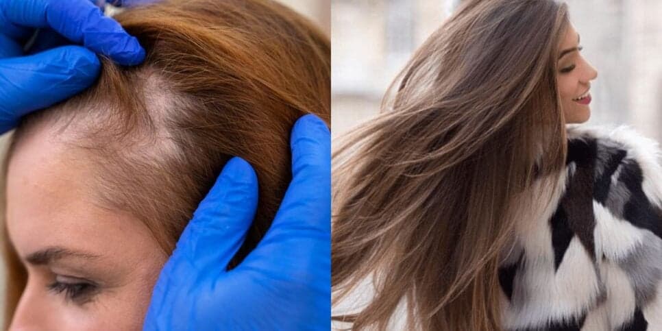 Queda de cabelo / Cabelo com brilho - Montagem TVFOCO Queda de cabelo / Cabelo com brilho - Montagem TVFOCO
