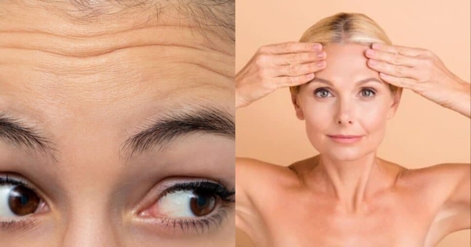 Fim das rugas na testa: Rejuvenesça 20 anos com 1 ingrediente (Foto: Reprodução/ Internet) Fim das rugas na testa: Rejuvenesça 20 anos com 1 ingrediente (Foto: Reprodução/ Internet)